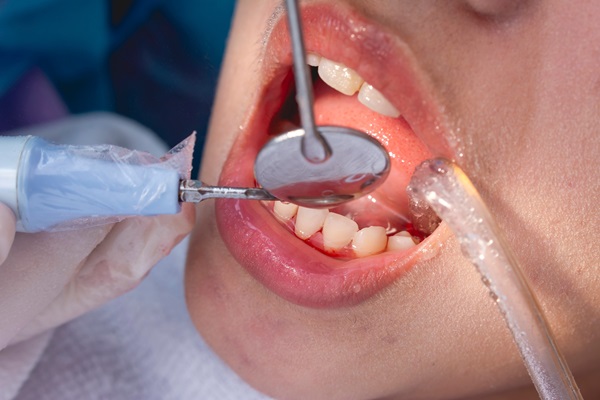 The FAQs Of A Deep Teeth Cleaning