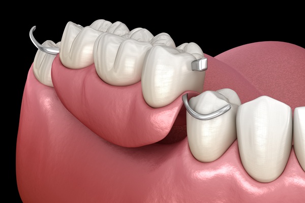 Types Of Dental Bridges: Choosing The Right Option For Your Smile