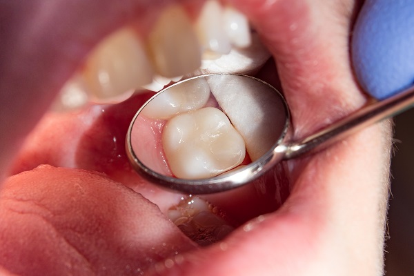 How A Dental Filling Is Used To Treat A Cavity