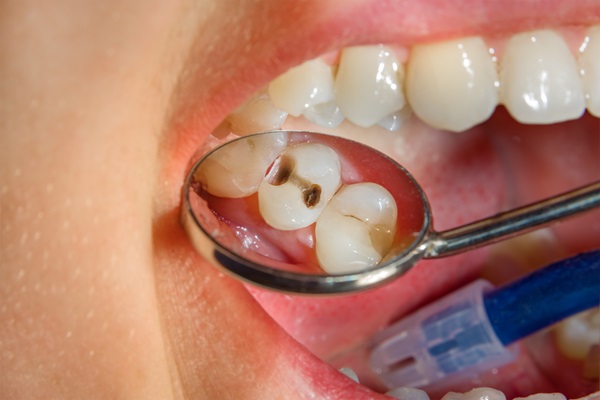 Dental Fillings To Repair A Cracked Tooth