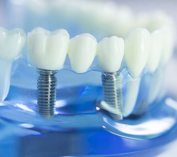 Boca Raton Dental Implants