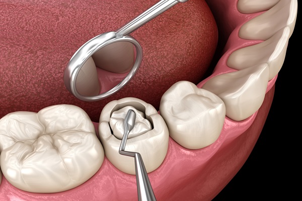 Do Dental Sealants Protect Children&#    ;s Teeth?