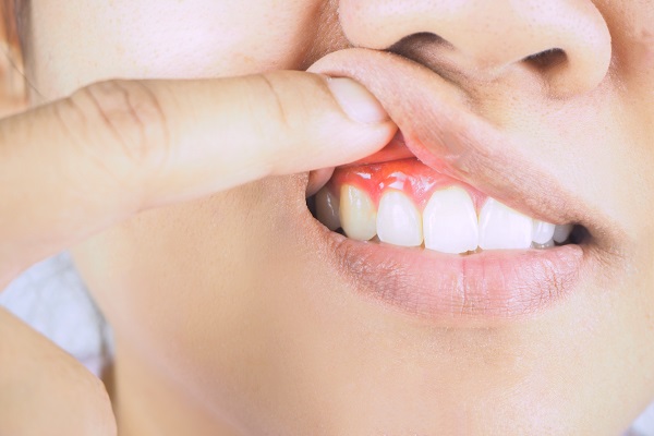 Treatment Options For Gum Recession